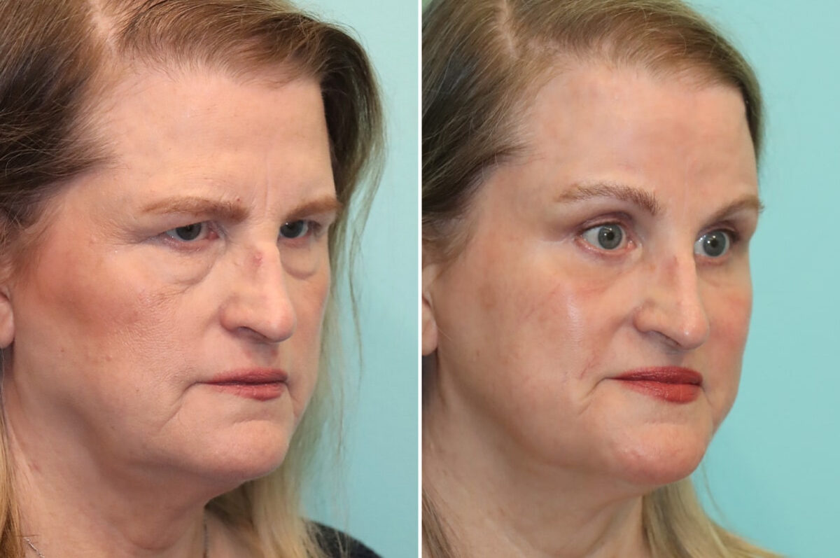 Blepharoplasty before and after at The Naderi Center, Reston, VA and Chevy Chase, MD, Patient 25772
