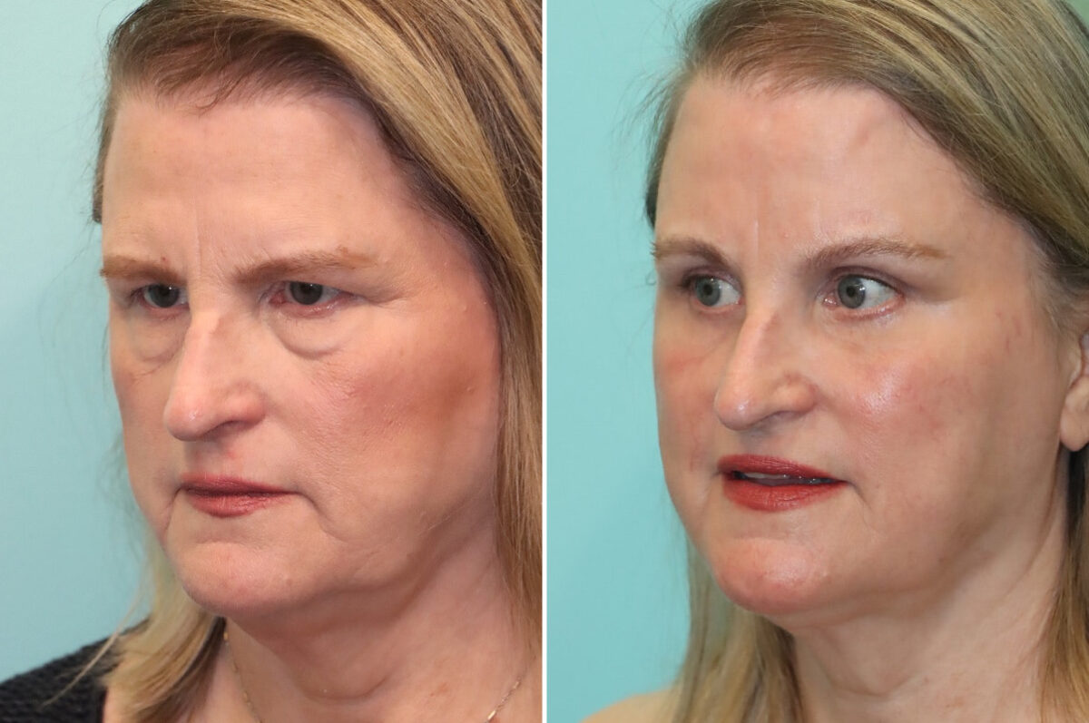 Blepharoplasty before and after at The Naderi Center, Reston, VA and Chevy Chase, MD, Patient 25772