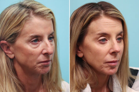 Rhinoplasty before and after at The Naderi Center, Reston, VA and Chevy Chase, MD, Patient 29997