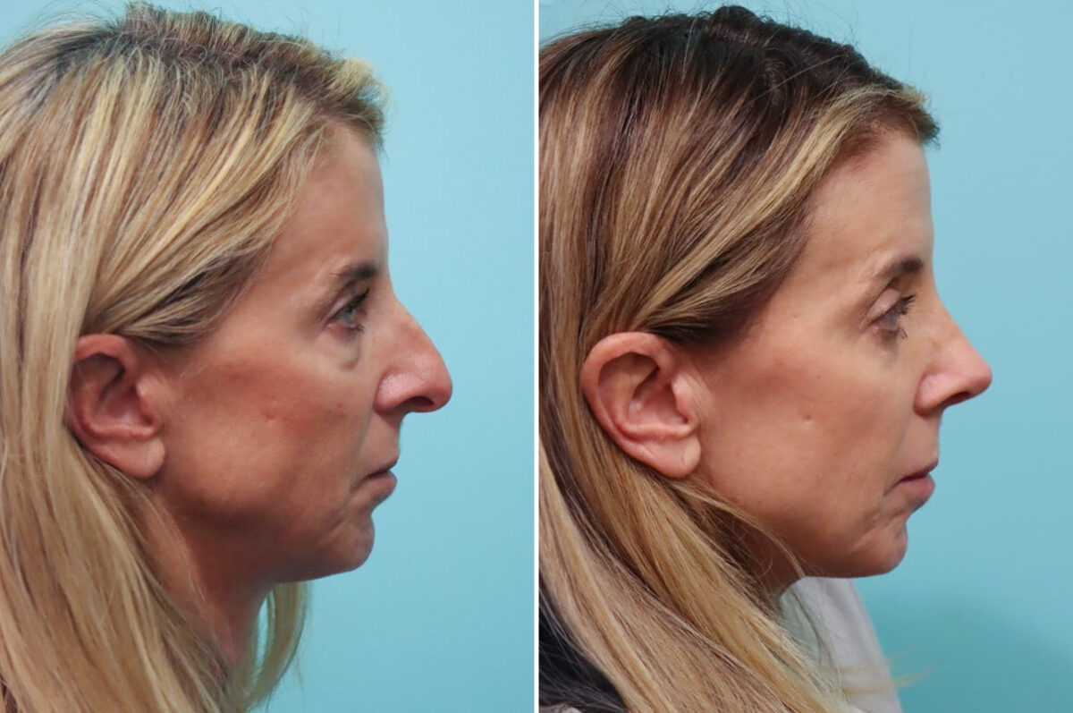 Light Therapy before and after, Patient 30023