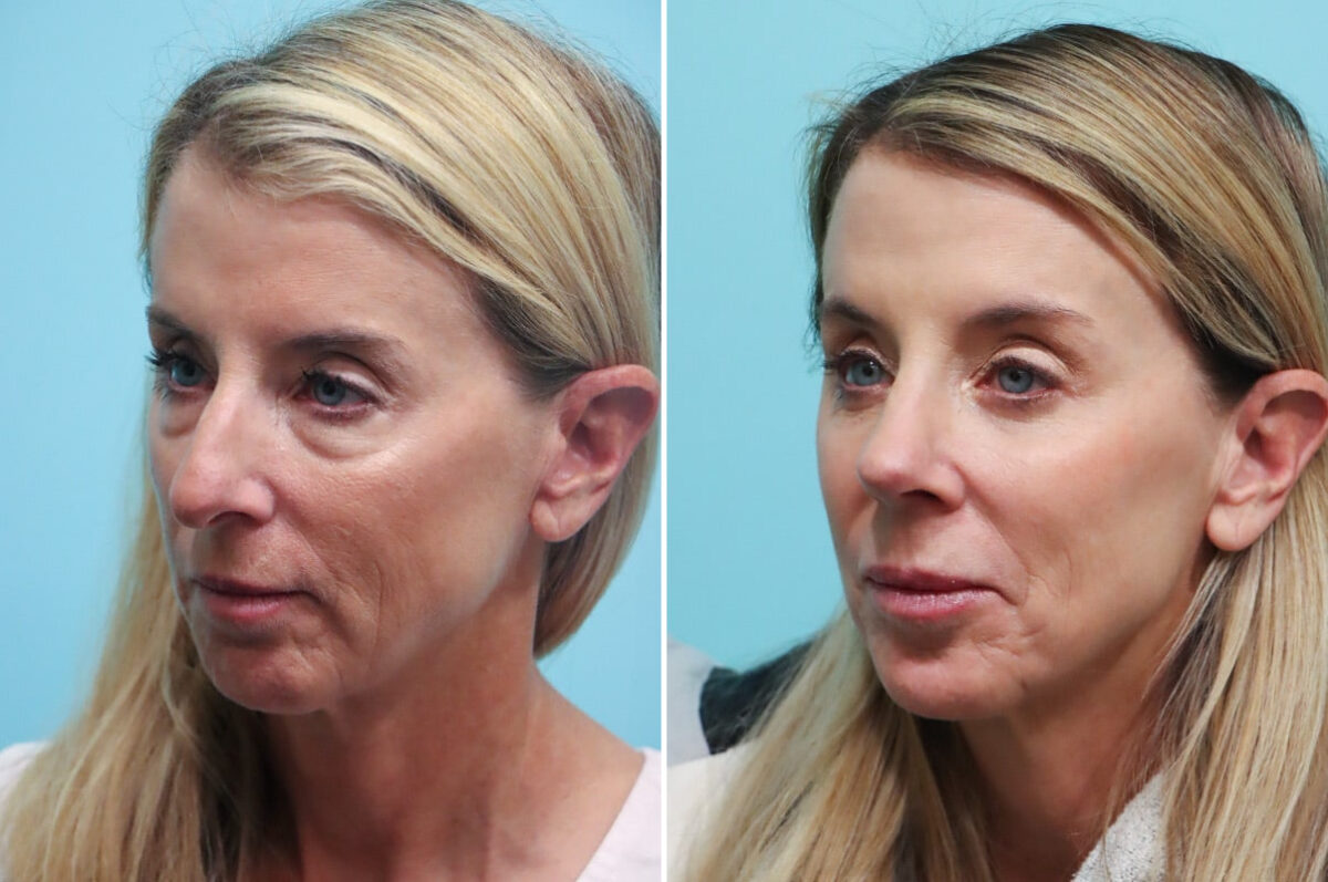 Light Therapy before and after, Patient 30023