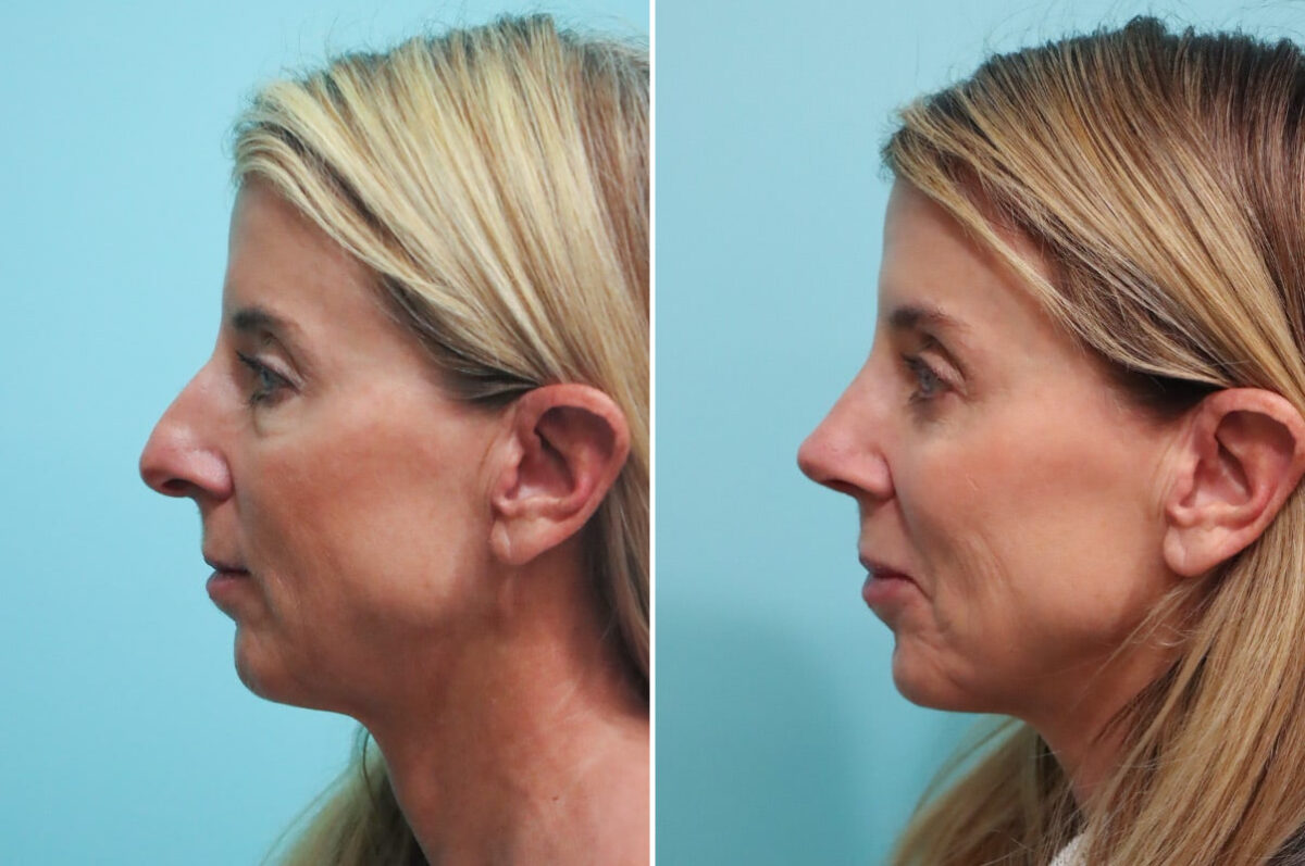 Light Therapy before and after, Patient 30023