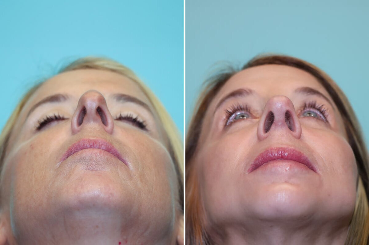 Light Therapy before and after, Patient 30023