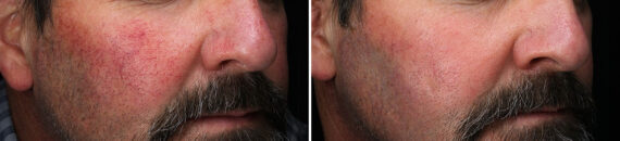 Light Therapy before and after, Patient 30102