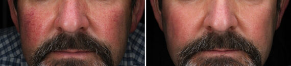 Light Therapy before and after, Patient 30102