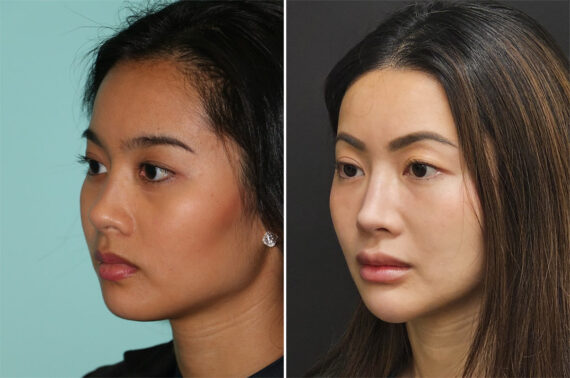 Cheeks / Midface Injections before and after at The Naderi Center, Reston, VA and Chevy Chase, MD, Patient 36609