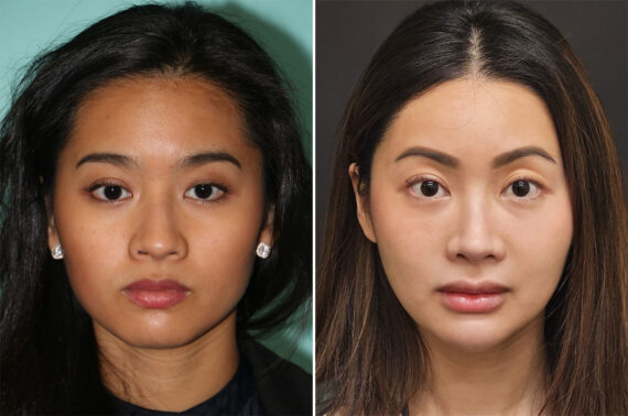 Cheeks / Midface Injections before and after at The Naderi Center, Reston, VA and Chevy Chase, MD, Patient 36609