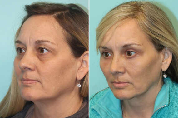 Fat Transfer before and after at The Naderi Center, Reston, VA and Chevy Chase, MD, Patient 37078