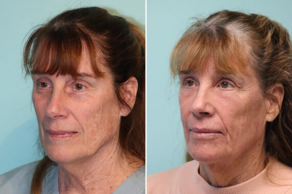 Fat Transfer before and after at The Naderi Center, Reston, VA and Chevy Chase, MD, Patient 37839
