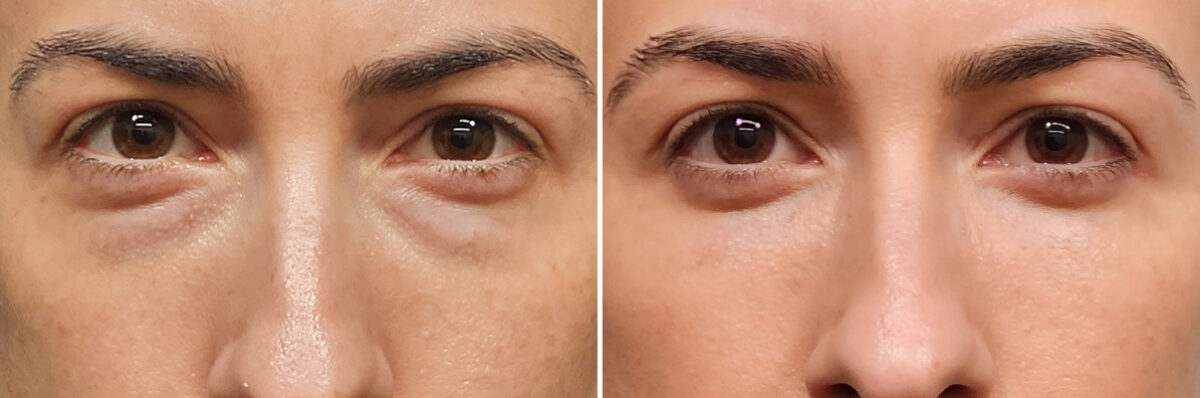 Blepharoplasty before and after at The Naderi Center, Reston, VA and Chevy Chase, MD, Patient 40241