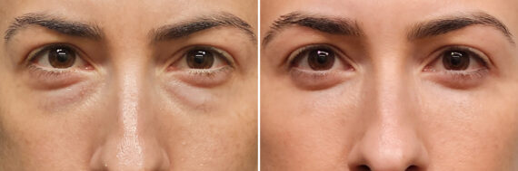 Blepharoplasty before and after at The Naderi Center, Reston, VA and Chevy Chase, MD, Patient 40241