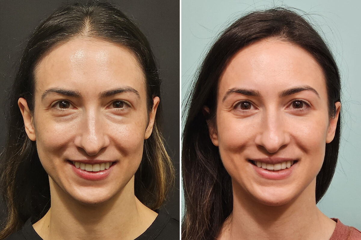 Blepharoplasty before and after at The Naderi Center, Reston, VA and Chevy Chase, MD, Patient 40241