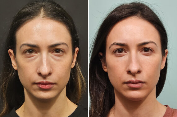 Blepharoplasty before and after at The Naderi Center, Reston, VA and Chevy Chase, MD, Patient 40241
