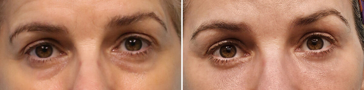 Blepharoplasty before and after at The Naderi Center, Reston, VA and Chevy Chase, MD, Patient 41150