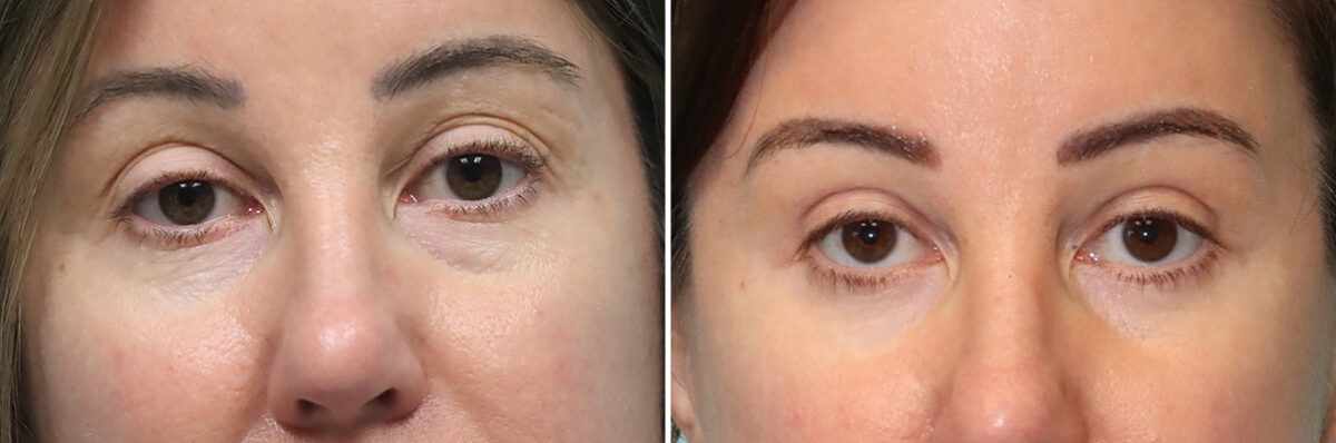 Blepharoplasty before and after at The Naderi Center, Reston, VA and Chevy Chase, MD, Patient 41944