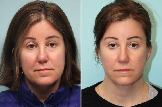Blepharoplasty before and after at The Naderi Center, Reston, VA and Chevy Chase, MD, Patient 41944