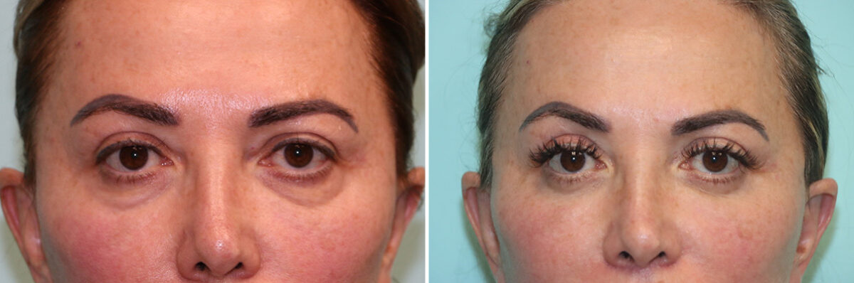 Blepharoplasty before and after at The Naderi Center, Reston, VA and Chevy Chase, MD, Patient 42033