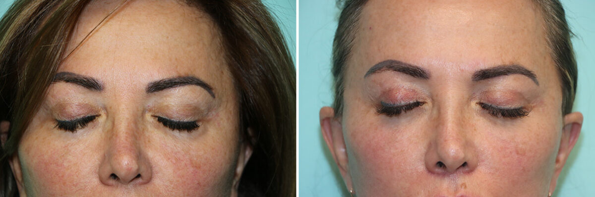 Blepharoplasty before and after at The Naderi Center, Reston, VA and Chevy Chase, MD, Patient 42033