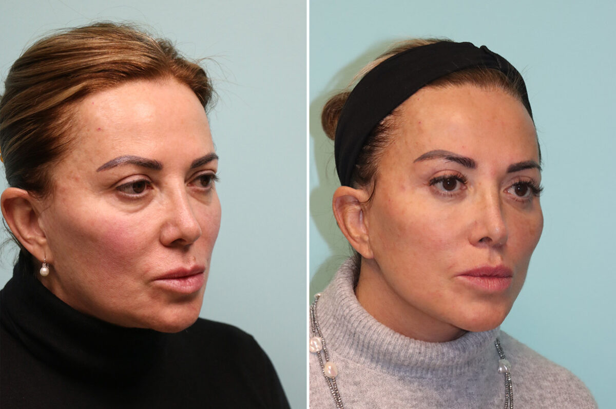 Blepharoplasty before and after at The Naderi Center, Reston, VA and Chevy Chase, MD, Patient 42033