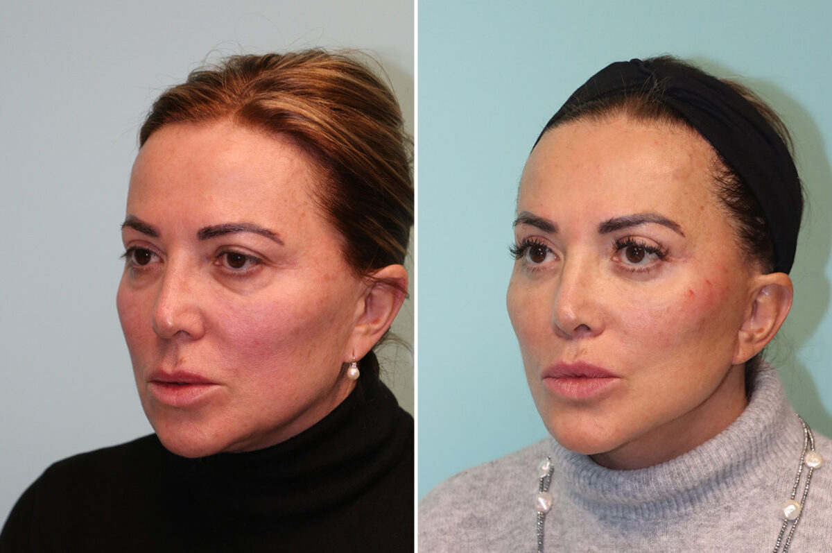 Blepharoplasty before and after at The Naderi Center, Reston, VA and Chevy Chase, MD, Patient 42033