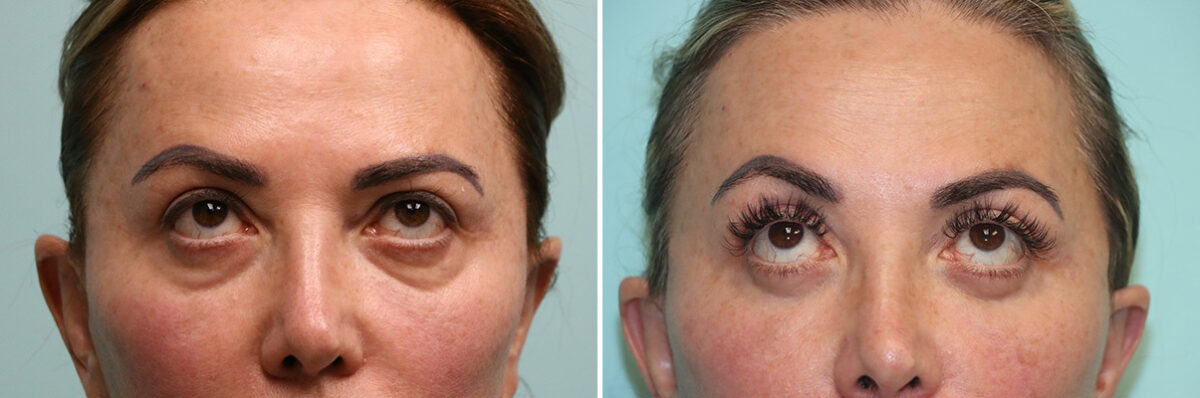 Blepharoplasty before and after at The Naderi Center, Reston, VA and Chevy Chase, MD, Patient 42033