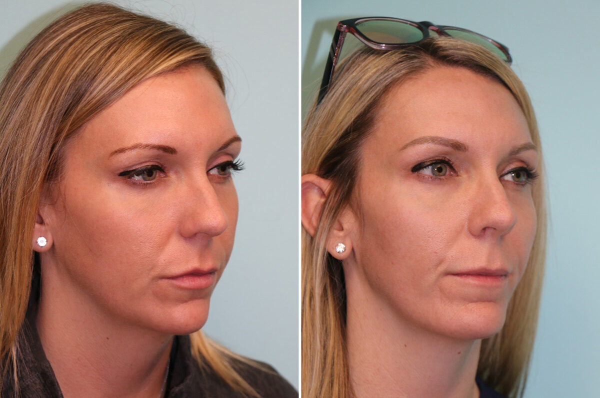 Chin & Facial Implant before and after at The Naderi Center, Reston, VA and Chevy Chase, MD, Patient 42628