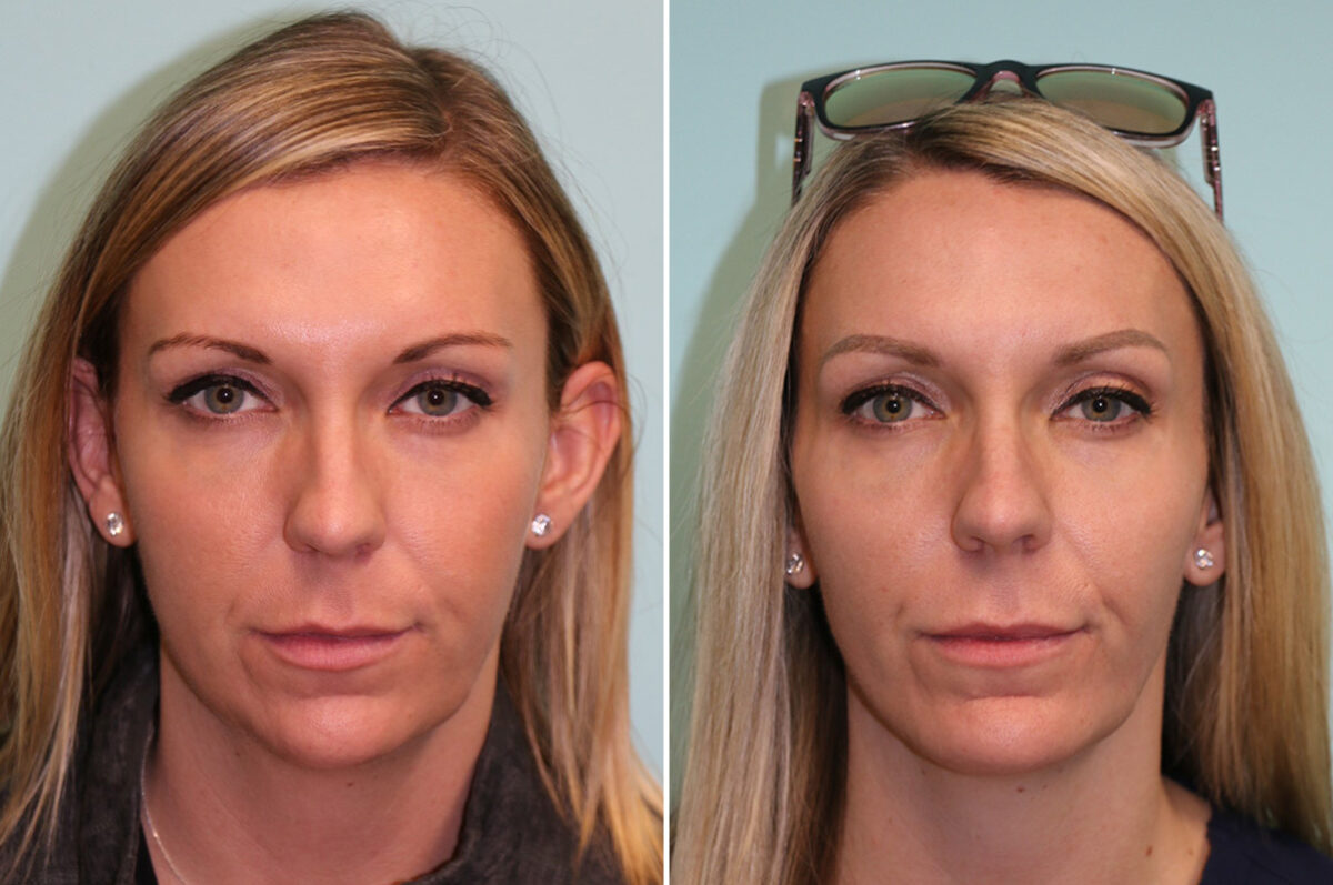 Chin & Facial Implant before and after at The Naderi Center, Reston, VA and Chevy Chase, MD, Patient 42628