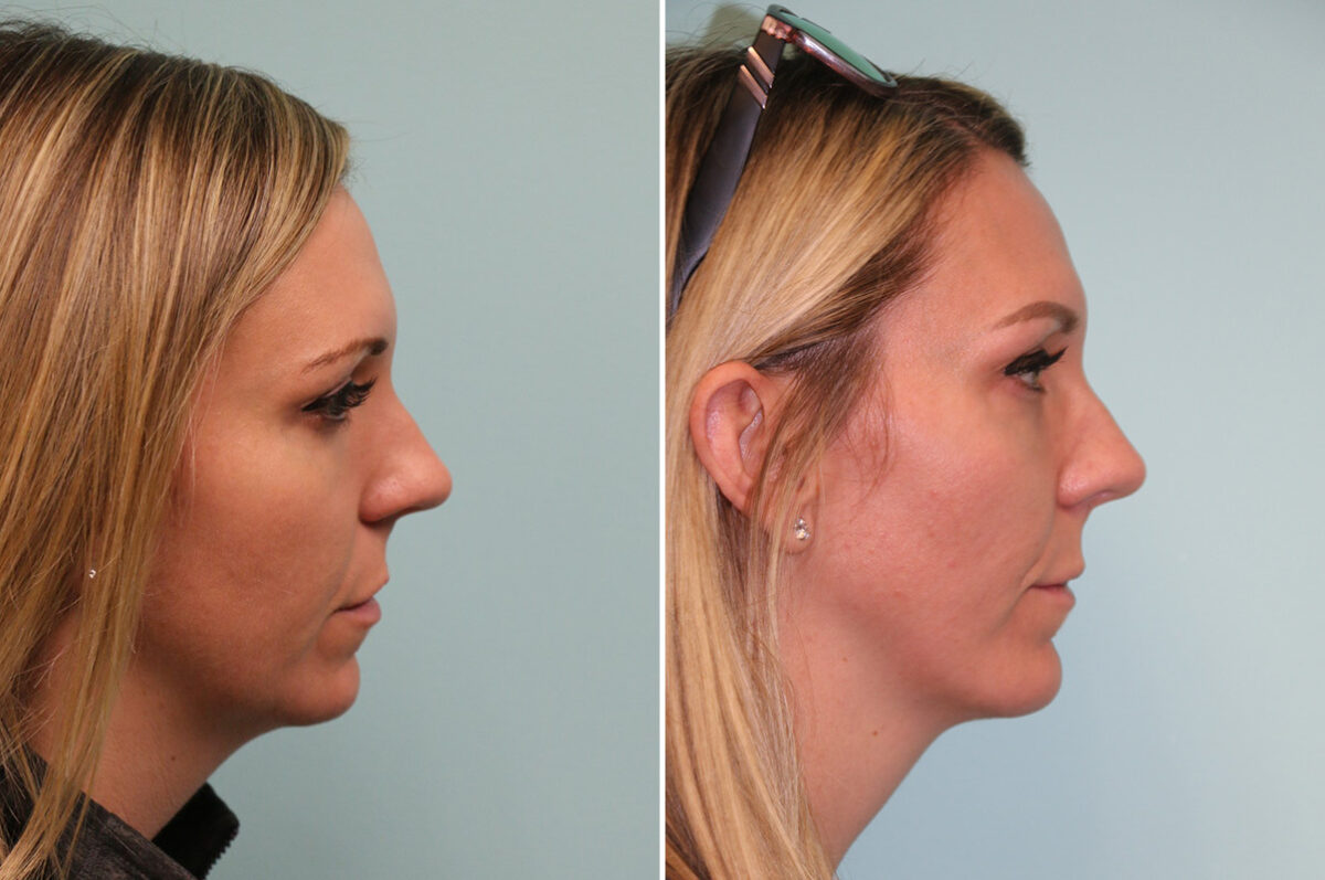 Chin & Facial Implant before and after at The Naderi Center, Reston, VA and Chevy Chase, MD, Patient 42628