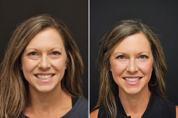 Blepharoplasty before and after at The Naderi Center, Reston, VA and Chevy Chase, MD, Patient 43116