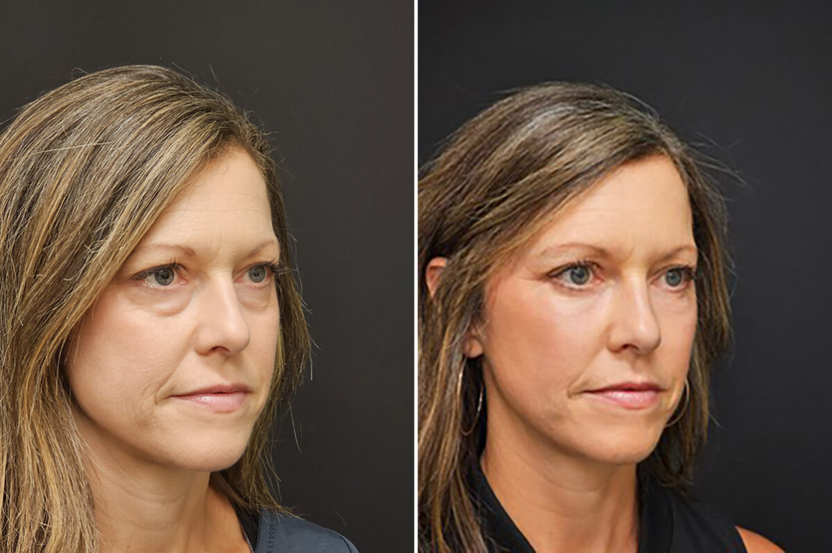 Blepharoplasty before and after at The Naderi Center, Reston, VA and Chevy Chase, MD, Patient 43116