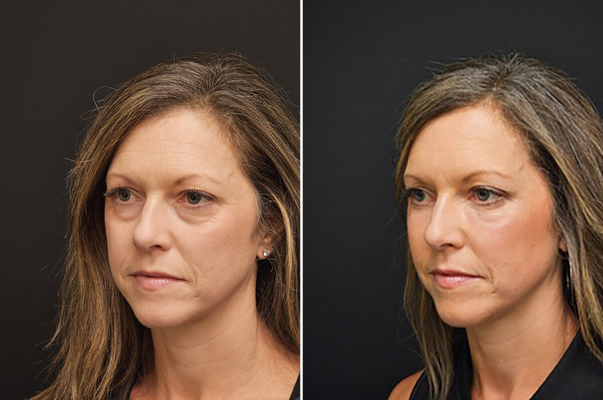 Blepharoplasty before and after at The Naderi Center, Reston, VA and Chevy Chase, MD, Patient 43116