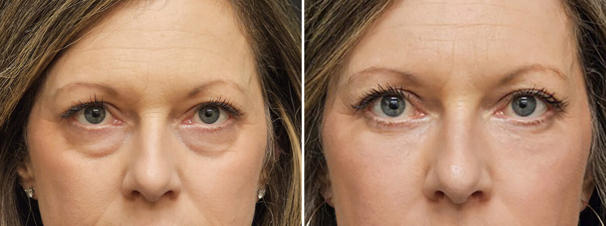 Blepharoplasty before and after at The Naderi Center, Reston, VA and Chevy Chase, MD, Patient 43116
