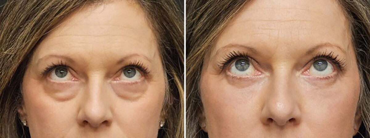 Blepharoplasty before and after at The Naderi Center, Reston, VA and Chevy Chase, MD, Patient 43116