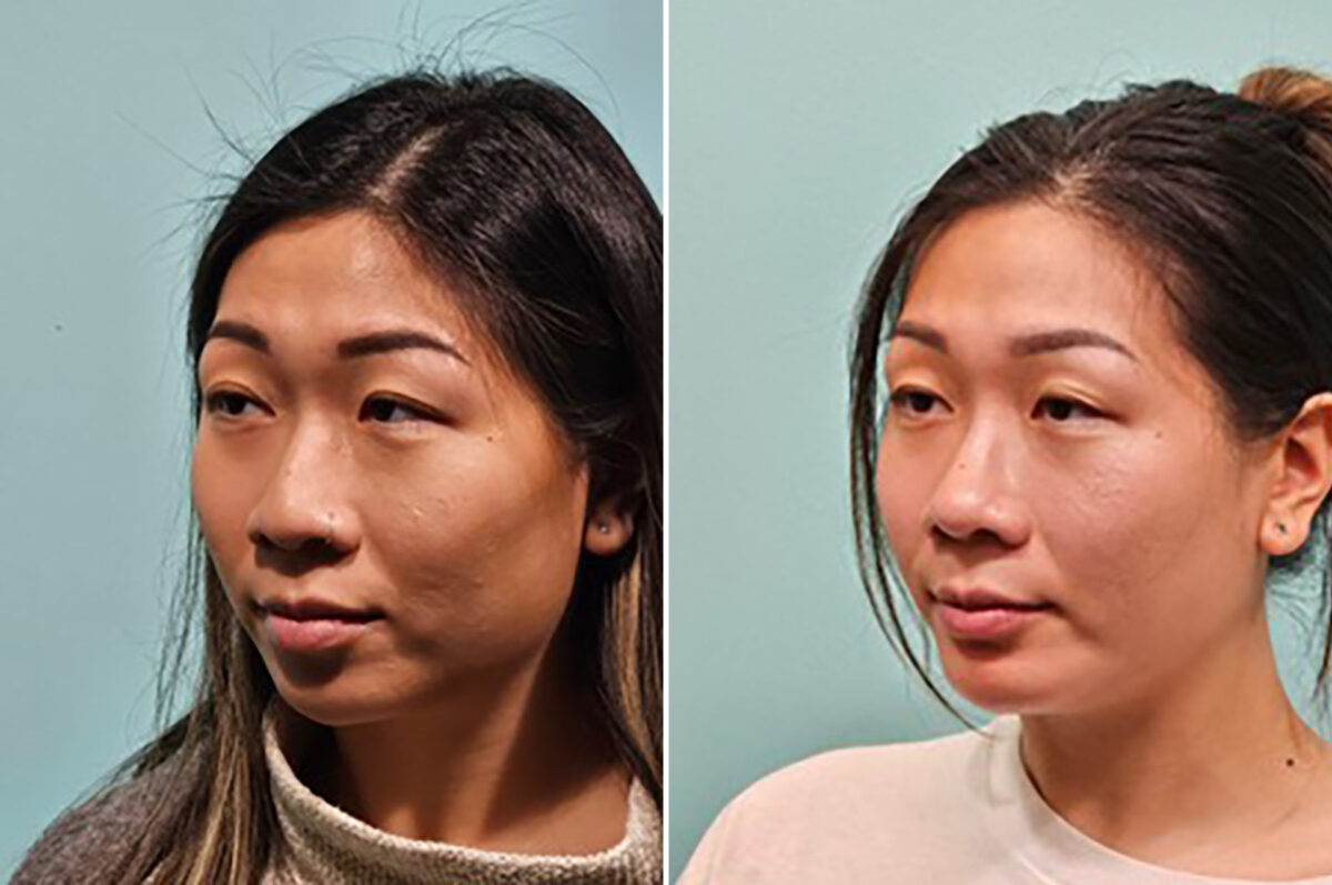 Chin & Facial Implant before and after at The Naderi Center, Reston, VA and Chevy Chase, MD, Patient 43752