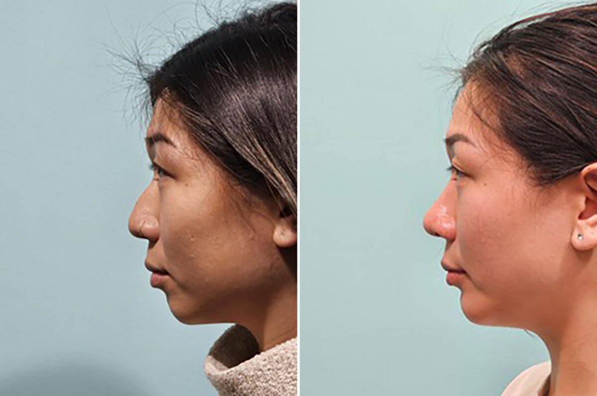 Chin & Facial Implant before and after at The Naderi Center, Reston, VA and Chevy Chase, MD, Patient 43752