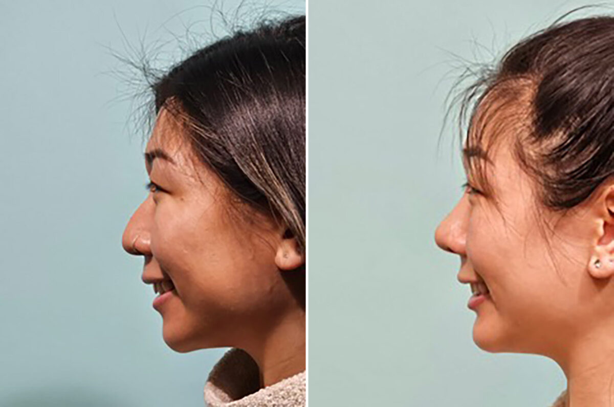 Chin & Facial Implant before and after at The Naderi Center, Reston, VA and Chevy Chase, MD, Patient 43752
