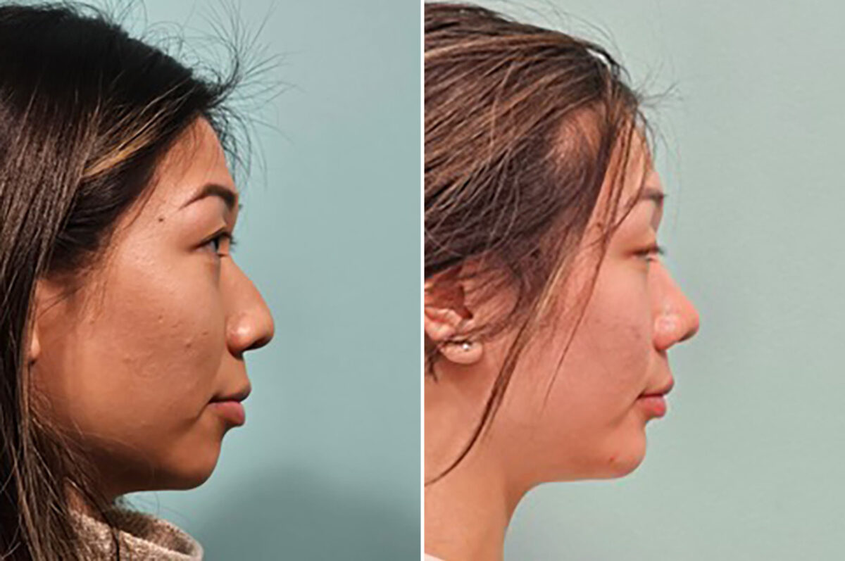 Chin & Facial Implant before and after at The Naderi Center, Reston, VA and Chevy Chase, MD, Patient 43752