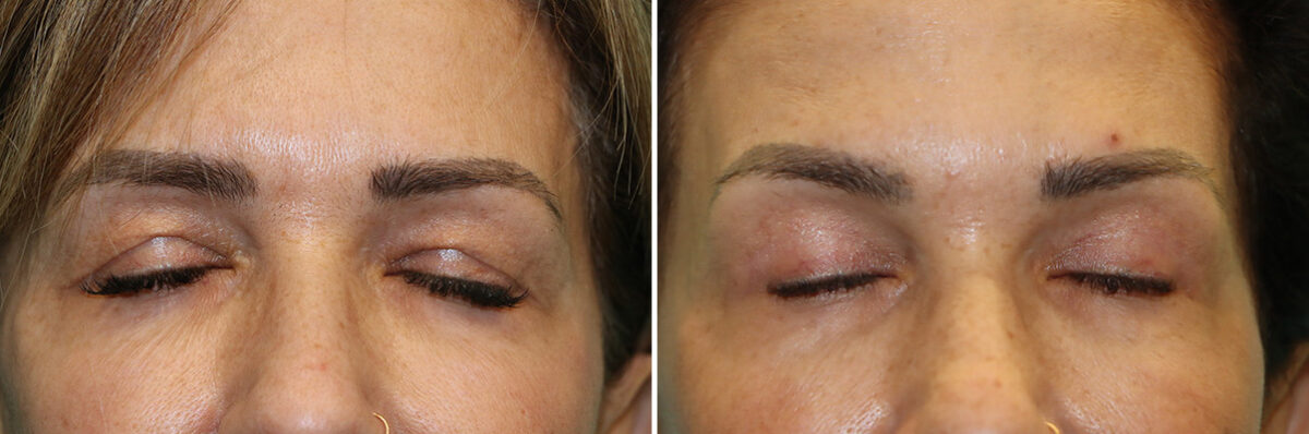 Blepharoplasty before and after at The Naderi Center, Reston, VA and Chevy Chase, MD, Patient 44366