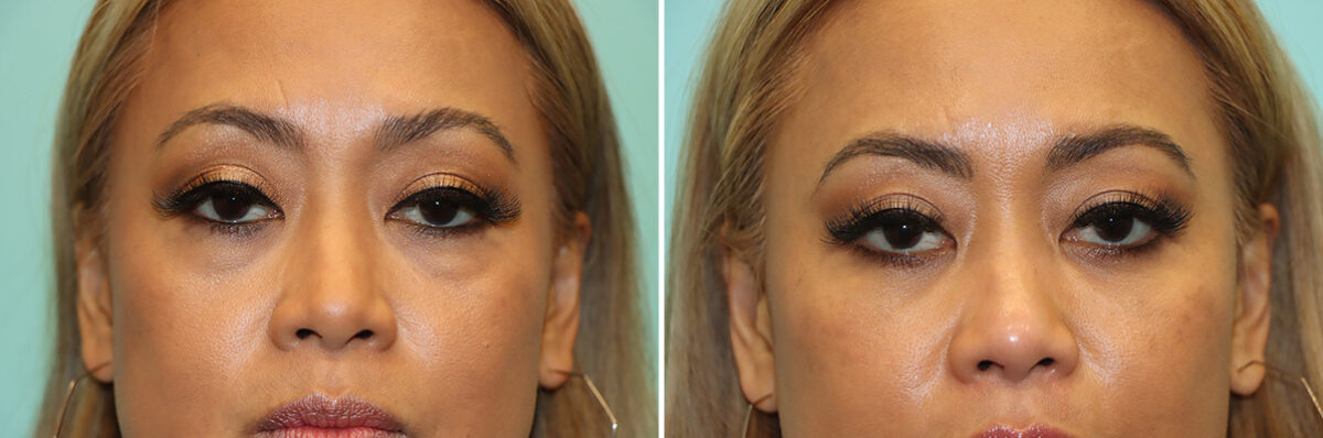 Blepharoplasty before and after at The Naderi Center, Reston, VA and Chevy Chase, MD, Patient 44724