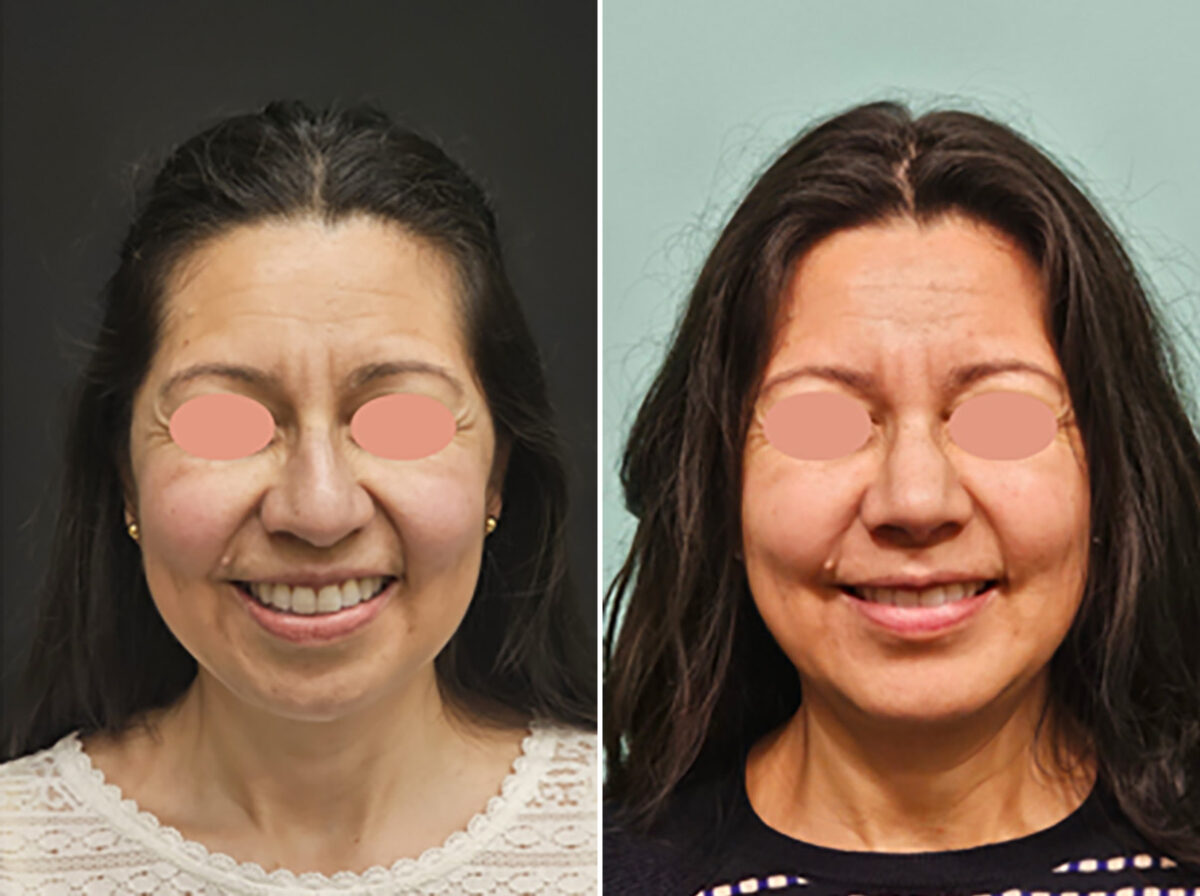Chin & Facial Implant before and after at The Naderi Center, Reston, VA and Chevy Chase, MD, Patient 45280