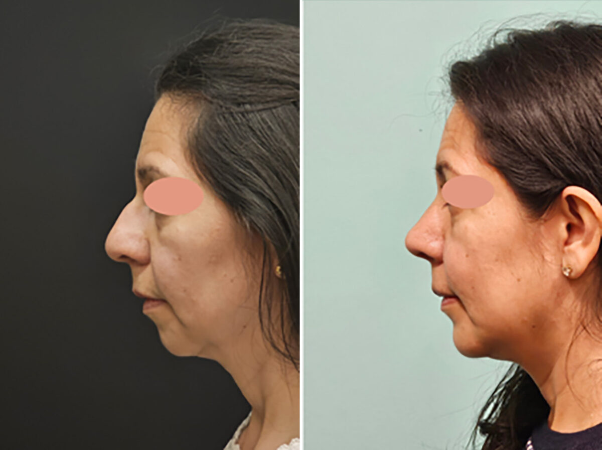 Chin & Facial Implant before and after at The Naderi Center, Reston, VA and Chevy Chase, MD, Patient 45280