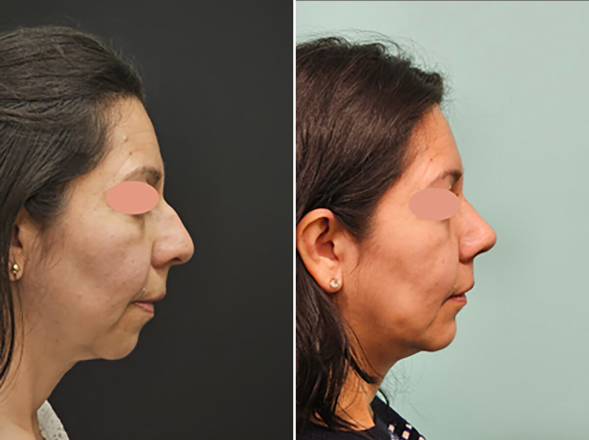 Chin & Facial Implant before and after at The Naderi Center, Reston, VA and Chevy Chase, MD, Patient 45280