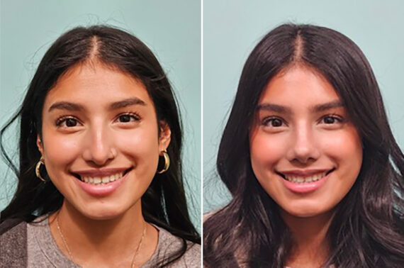 Rhinoplasty before and after at The Naderi Center, Reston, VA and Chevy Chase, MD, Patient 49893