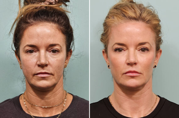 Before and after Morpheus8 by Dr. Shervin Naderi, Patient 52060