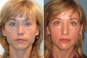 Blepharoplasty before and after at The Naderi Center, Reston, VA and Chevy Chase, MD, Patient 56779