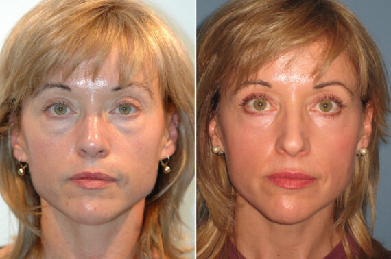 Blepharoplasty before and after at The Naderi Center, Reston, VA and Chevy Chase, MD, Patient 56779
