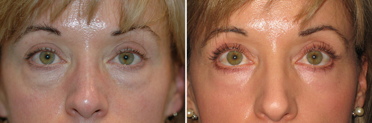 Blepharoplasty before and after at The Naderi Center, Reston, VA and Chevy Chase, MD, Patient 56779
