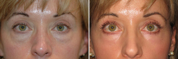 Blepharoplasty before and after at The Naderi Center, Reston, VA and Chevy Chase, MD, Patient 56779