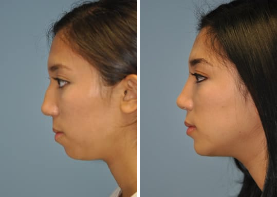 Rhinoplasty before and after at The Naderi Center, Reston, VA and Chevy Chase, MD, Patient 8881