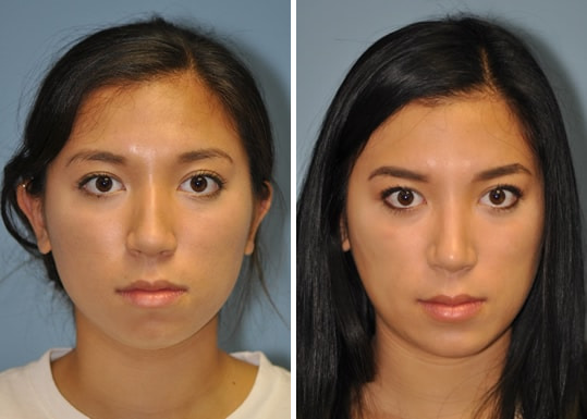 Rhinoplasty before and after at The Naderi Center, Reston, VA and Chevy Chase, MD, Patient 8881